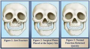 Facial Trauma