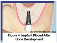 Sinus Lift Surgery