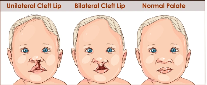 Orofacial reconstruction
