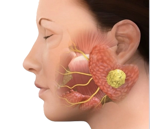 Salivary gland disease