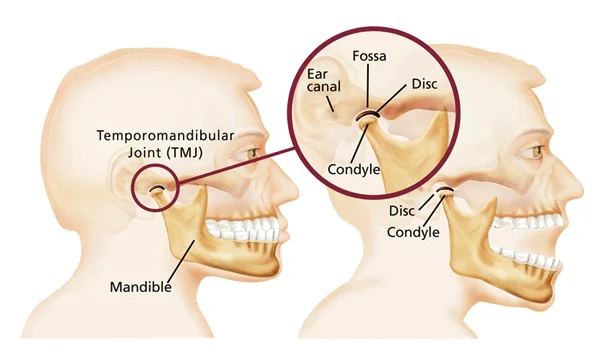 TMJ Disorder