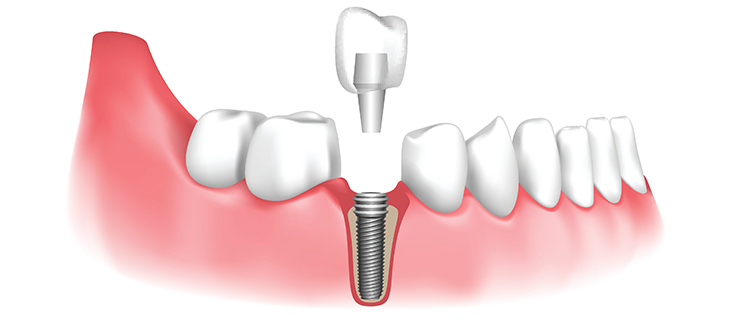 Dental Implants in Dadar