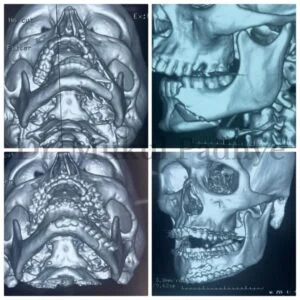 Facial trauma