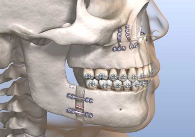 orthognathic surgery