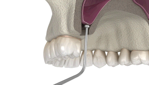 tooth extraction