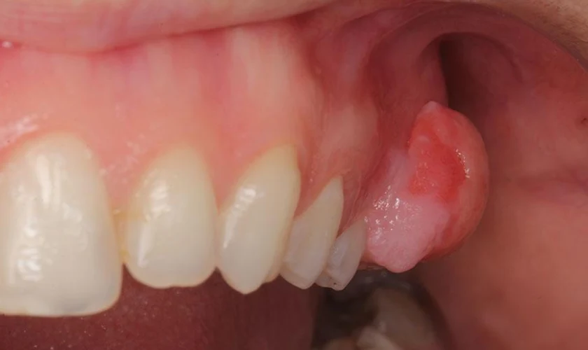 Oral cysts and tumor
