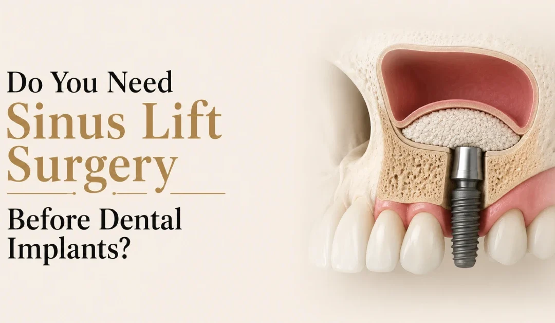 Do You Need a Sinus Lift Before Dental Implants?
